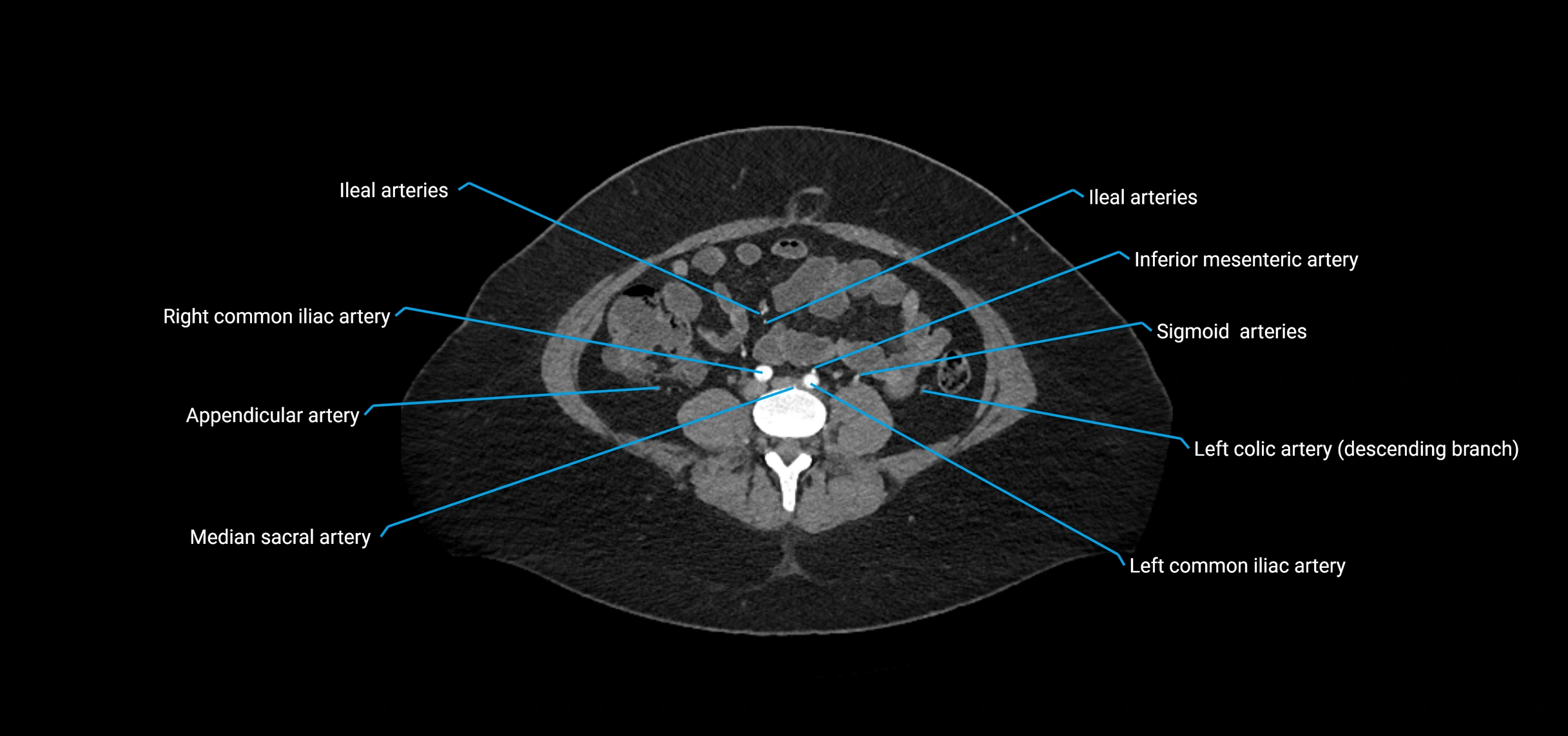 CTA abdomen axial cross sectional anatomy labelled image_147 (2).webp